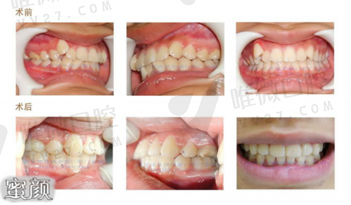 牙齿涂氟和窝沟封闭多少钱,窝沟封闭清洁牙面详细步骤(图1)